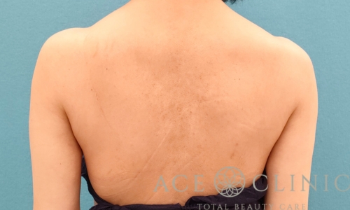 脂肪吸引｜上腕＋二の腕｜症例17｜35歳女性｜術後3ヶ月｜エースクリニック名古屋院