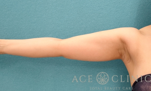 脂肪吸引｜上腕＋二の腕｜症例17｜35歳女性｜術前｜エースクリニック名古屋院
