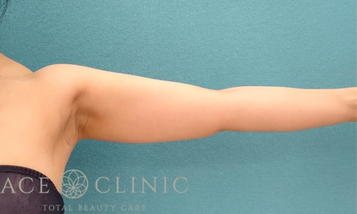 脂肪吸引｜上腕＋二の腕｜症例17｜35歳女性｜術前｜エースクリニック名古屋院