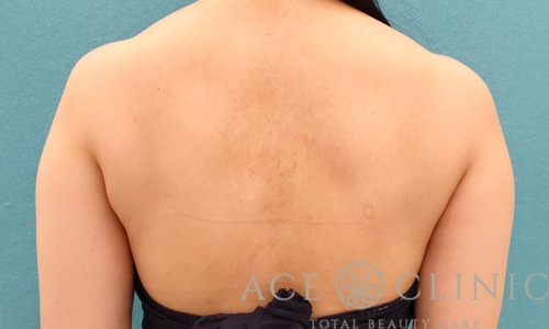 脂肪吸引｜上腕＋二の腕｜症例17｜35歳女性｜術前｜エースクリニック名古屋院