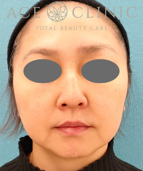 オンダリフト｜症例6｜女性｜術後1ヶ月｜エースクリニック名古屋