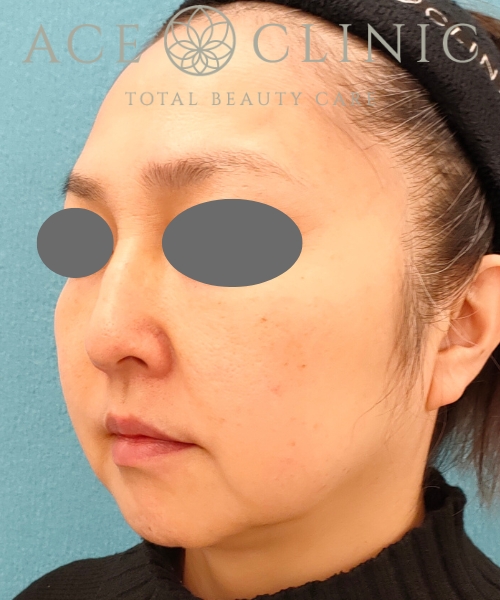 オンダリフト|症例6|女性|術後1ヶ月|エースクリニック名古屋