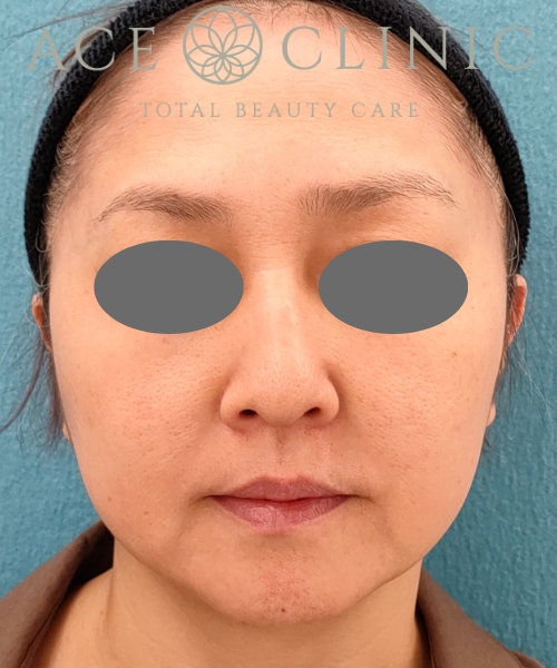 オンダリフト｜症例6｜女性｜術前｜エースクリニック名古屋