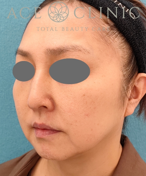 オンダリフト|症例6|女性|術前|エースクリニック名古屋