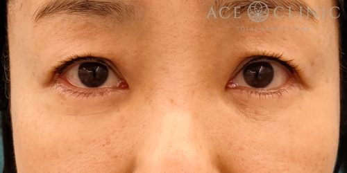 皮切ハムラ法｜症例30｜50代女性｜術後3ヶ月｜正面｜エースクリニック名古屋院