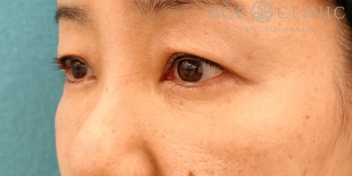 皮切ハムラ法|症例30|50代女性|術後3ヶ月|正面|エースクリニック名古屋院