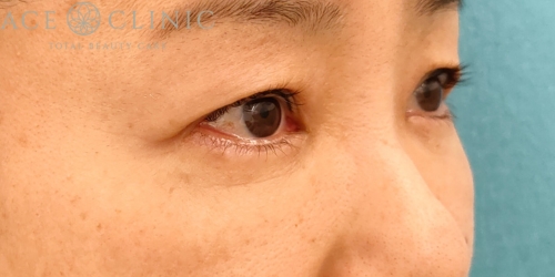 皮切ハムラ法|症例30|50代女性|術後3ヶ月|正面|エースクリニック名古屋院