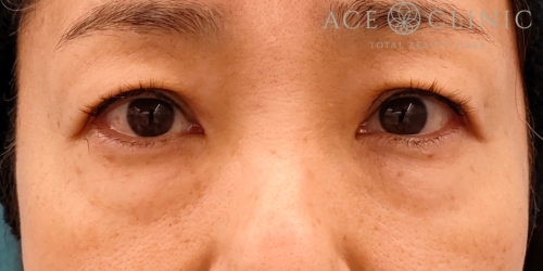 皮切ハムラ法｜症例30｜50代女性｜術前｜正面｜エースクリニック名古屋院