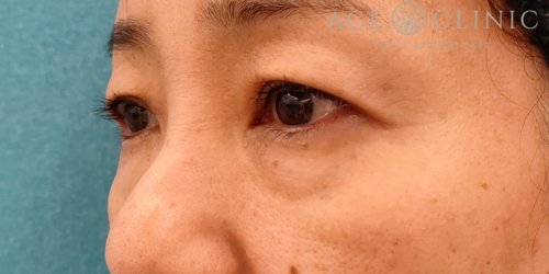 皮切ハムラ法|症例30|50代女性|術前|正面|エースクリニック名古屋院