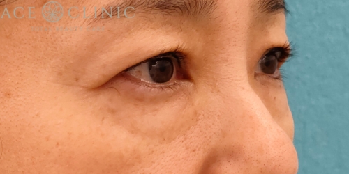 皮切ハムラ法|症例30|50代女性|術前|正面|エースクリニック名古屋院