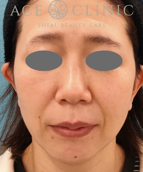 ピコトリプル|症例1|女性|術後3回目1ヵ月|エースクリニック名古屋院