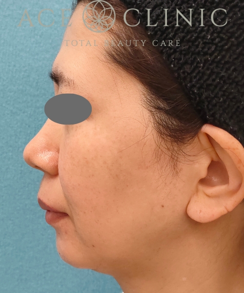 ピコトリプル｜症例1｜女性｜術後3回目1ヵ月｜エースクリニック名古屋院