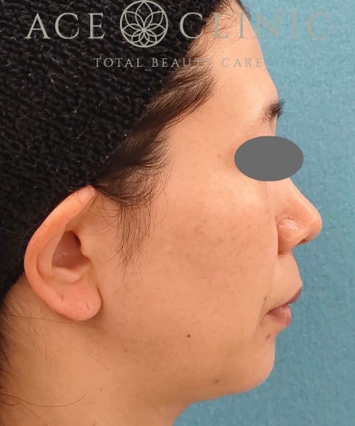 ピコトリプル｜症例1｜女性｜術後3回目1ヵ月｜エースクリニック名古屋院