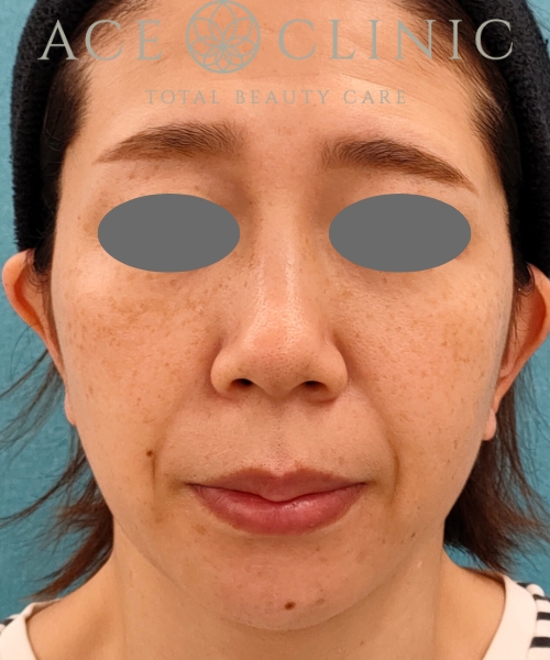 ピコトリプル|症例1|女性|術前3回目1ヵ月|エースクリニック名古屋院