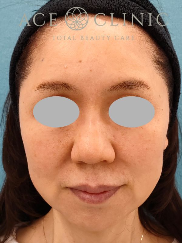 糸リフト｜50代女性｜術後1ヶ月｜エースクリニック名古屋院