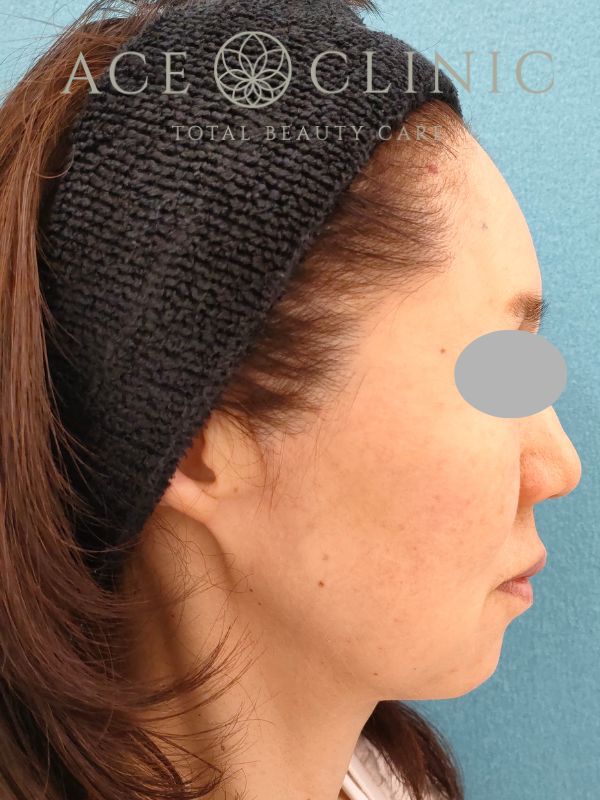 糸リフト｜50代女性｜術後1ヶ月｜エースクリニック名古屋院