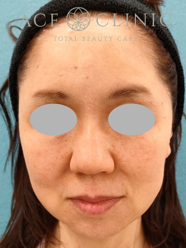 糸リフト｜50代女性｜術前｜エースクリニック名古屋院