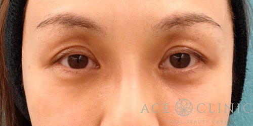 脱脂CRF法｜症例31｜40代女性｜術後3ヶ月｜エースクリニック名古屋院