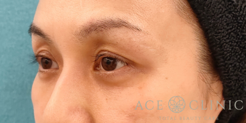 脱脂CRF法｜症例31｜40代女性｜術後3ヶ月｜エースクリニック名古屋院