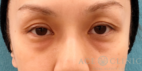 脱脂CRF法｜症例31｜40代女性｜術前｜正面｜エースクリニック名古屋院