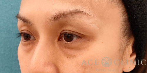 脱脂CRF法｜症例31｜40代女性｜術前｜エースクリニック名古屋院