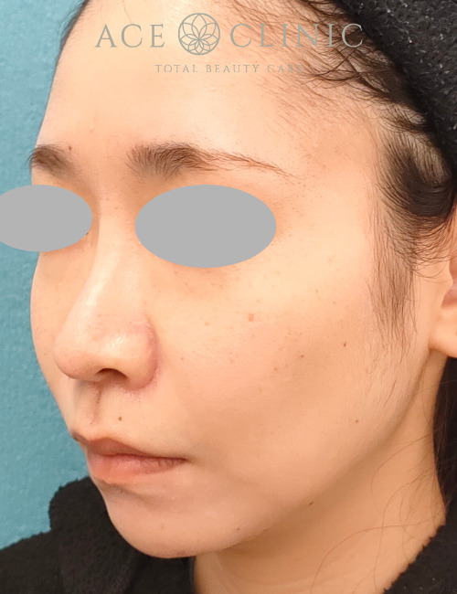 ザーフ|症例7|30代女性|3回術後2か月|エースクリニック名古屋院