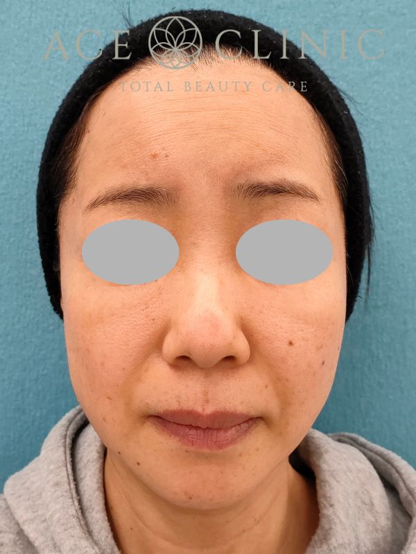 脂肪注入｜症例19｜50代女性｜術後3ヶ月｜エースクリニック名古屋院