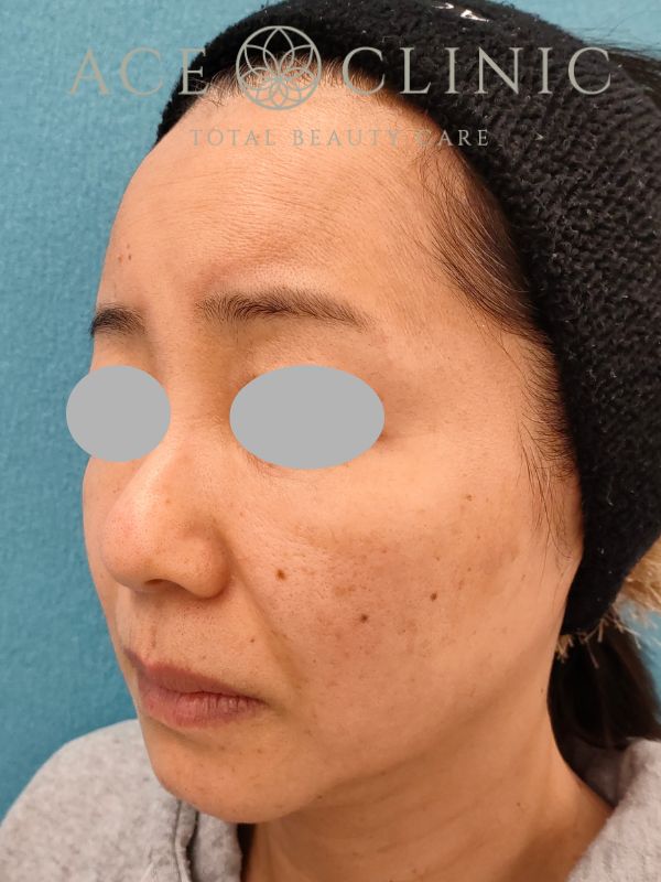 脂肪注入｜症例19｜50代女性｜術後3ヶ月｜エースクリニック名古屋院