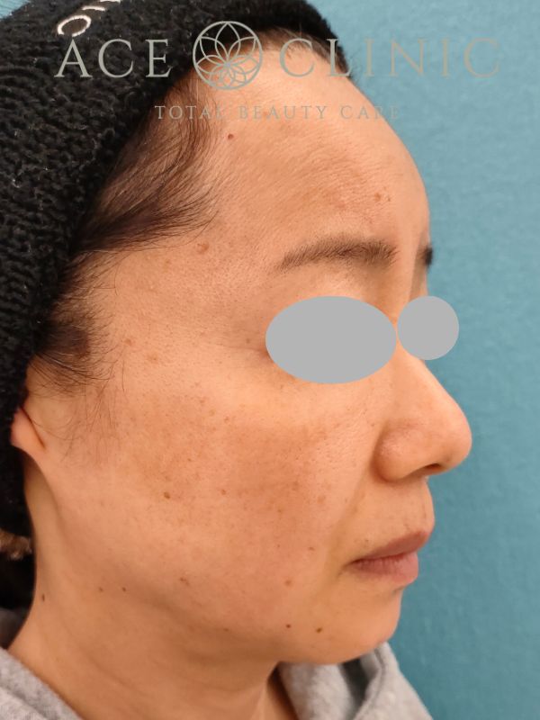 脂肪注入｜症例19｜50代女性｜術後3ヶ月｜エースクリニック名古屋院