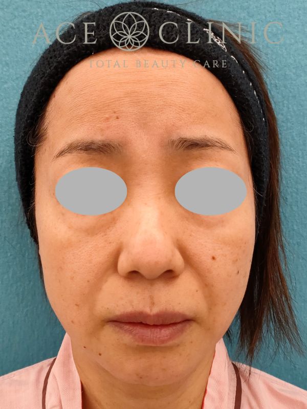 脂肪注入｜症例19｜50代女性｜術前｜エースクリニック名古屋院