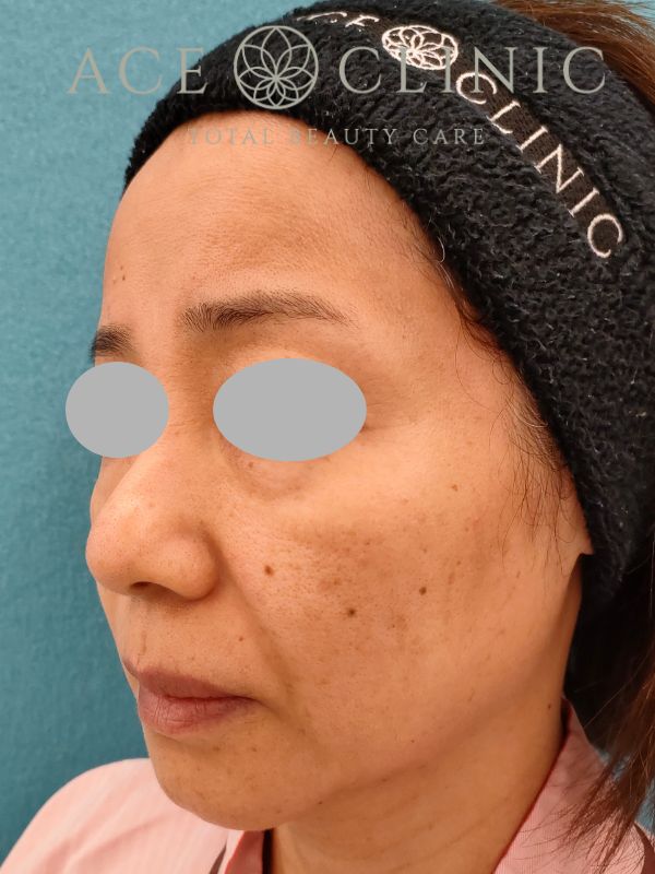脂肪注入｜症例19｜50代女性｜術前｜エースクリニック名古屋院