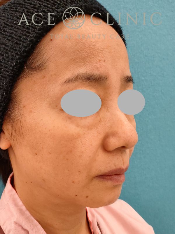 脂肪注入｜症例19｜50代女性｜術前｜エースクリニック名古屋院