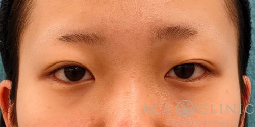 二重埋没法｜症例56｜10代女性｜術後3ヶ月｜エースクリニック名古屋院