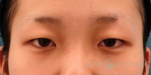 二重埋没法｜症例56｜10代女性｜術前｜エースクリニック名古屋院