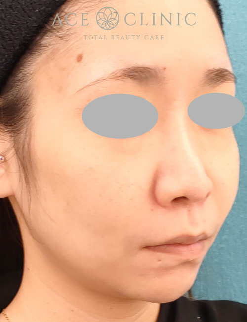 ザーフ|症例7|30代女性|術前|エースクリニック名古屋院