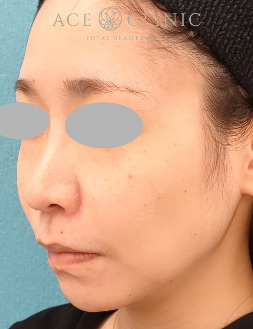 ザーフ|症例7|30代女性|術前|エースクリニック名古屋院