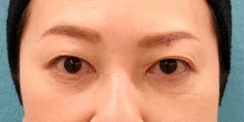眉毛下切開｜症例61｜50代女性｜術後3ヶ月｜エースクリニック名古屋院