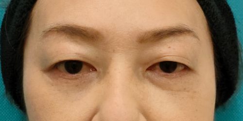 眉毛下切開｜症例61｜50代女性｜術前｜エースクリニック名古屋院