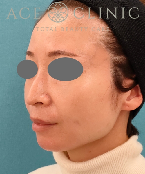 ザーフ|症例5|40代女性|3回術後2ヶ月|エースクリニック名古屋院