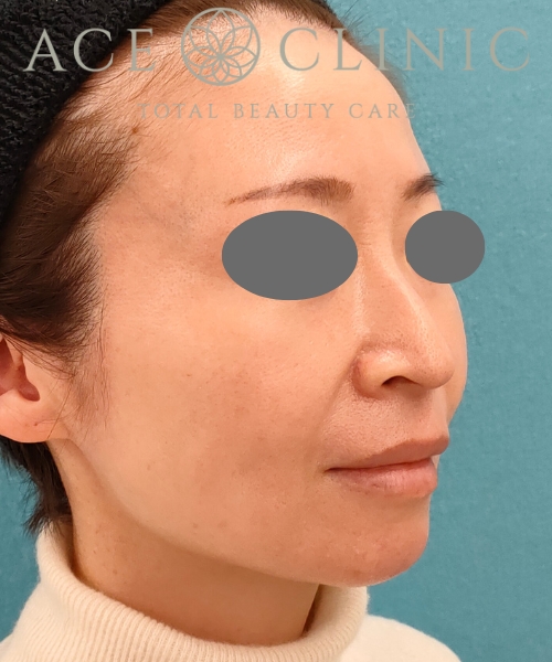 ザーフ|症例5|40代女性|3回術後2ヶ月|エースクリニック名古屋院