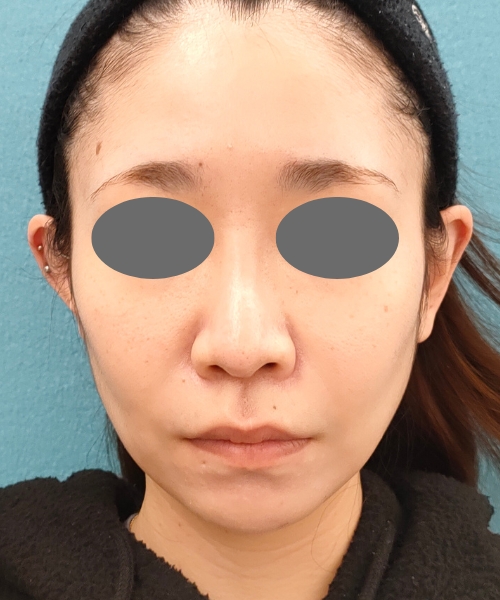 ザーフ｜症例7｜30代女性｜3回術後2ヶ月｜エースクリニック名古屋院