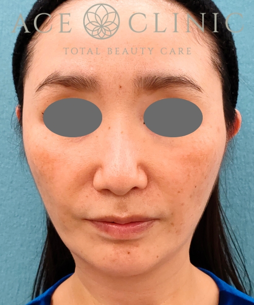 ザーフ｜症例6｜50代女性｜3回術後2ヶ月｜エースクリニック名古屋院
