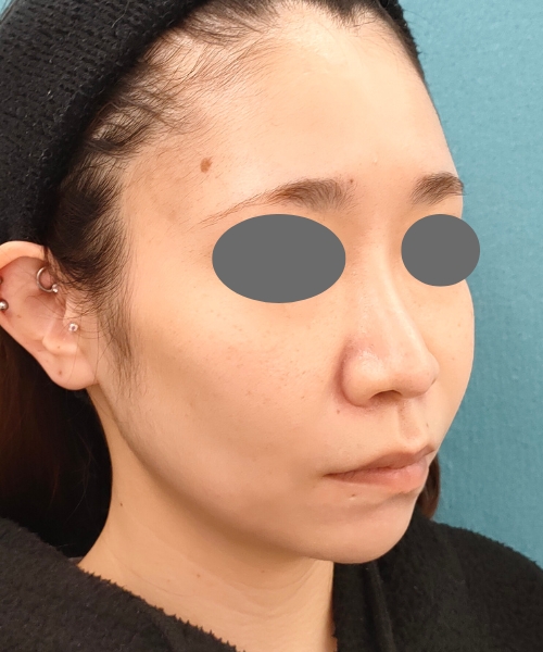 ザーフ｜症例7｜30代女性｜3回術後2ヶ月｜エースクリニック名古屋院