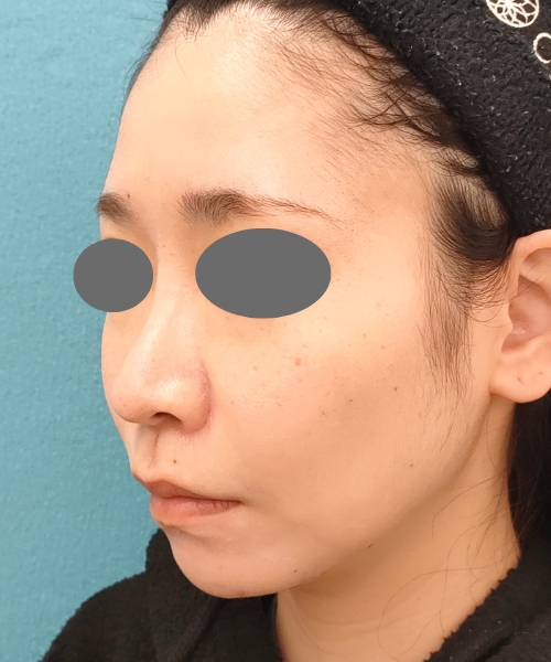 ザーフ｜症例7｜30代女性｜3回術後2ヶ月｜エースクリニック名古屋院