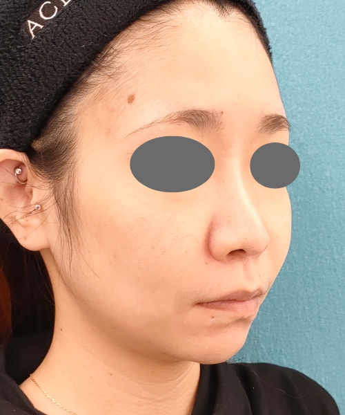 ザーフ｜症例7｜30代女性｜3回前｜エースクリニック名古屋院