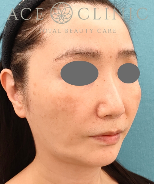 ザーフ｜症例6｜50代女性｜3回術前｜エースクリニック名古屋院