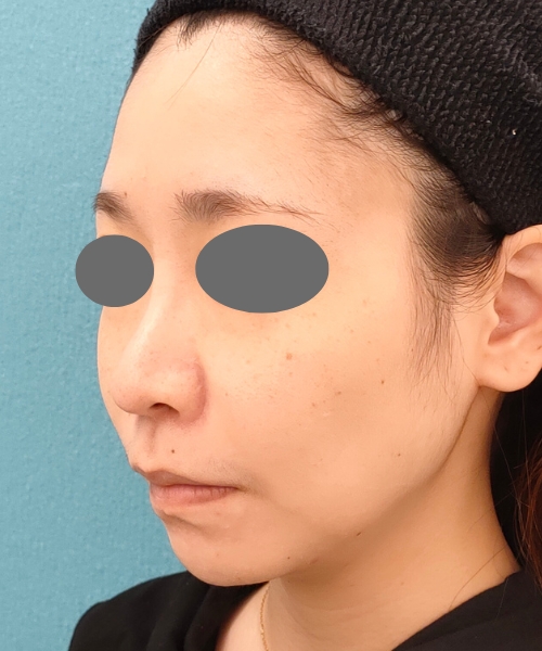 ザーフ｜症例7｜30代女性｜3回前｜エースクリニック名古屋院