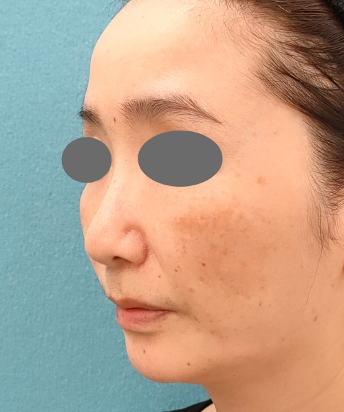 ザーフ｜症例6｜50代女性｜3回術前｜エースクリニック名古屋院
