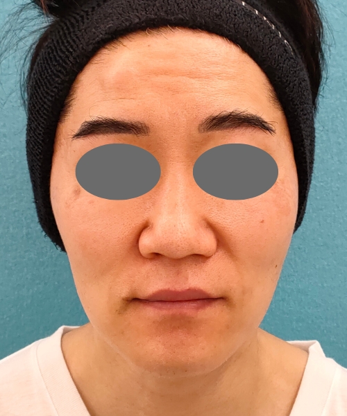 ザーフ｜症例8｜40代男性｜3回終了後1m｜エースクリニック名古屋院