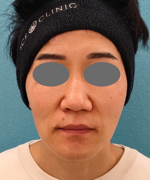 ザーフ｜症例8｜40代男性｜術前｜エースクリニック名古屋院